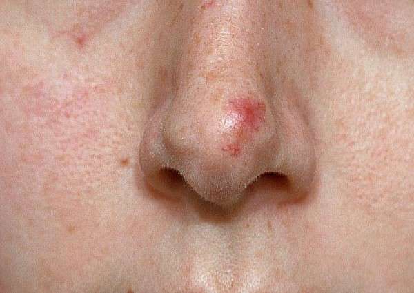 Best safe treatment for Red Marks, Acne, & Veins